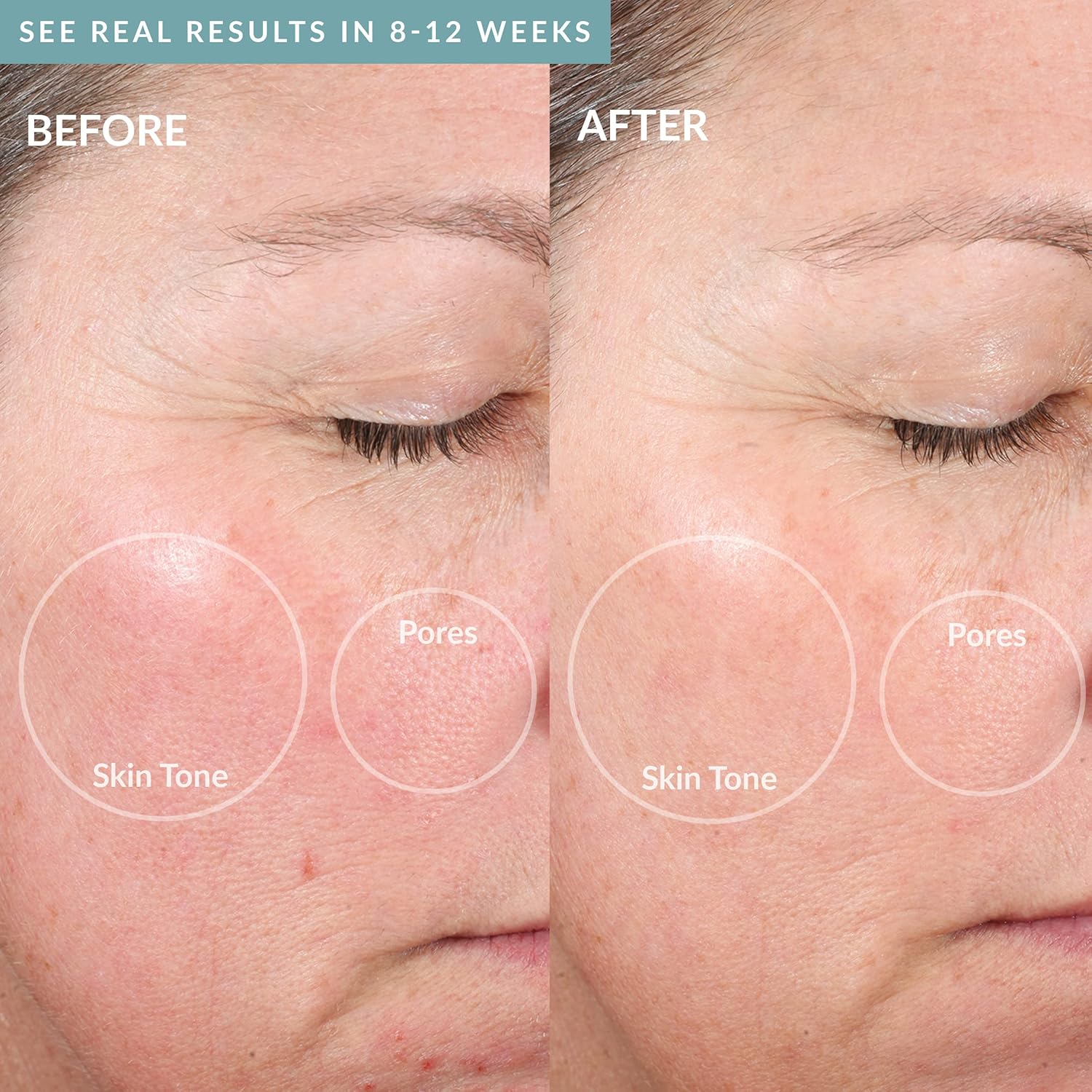 PMD Personal Microderm Elite Pro – At-Home - Image 3